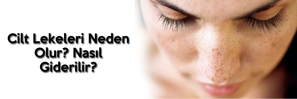 Cilt Lekeleri Neden Olur? Ne İyi Gelir?